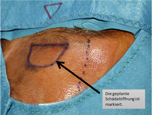 OP-Planung durch die Augenbraue; Quelle: PD Dr. med. Albrecht Waschke